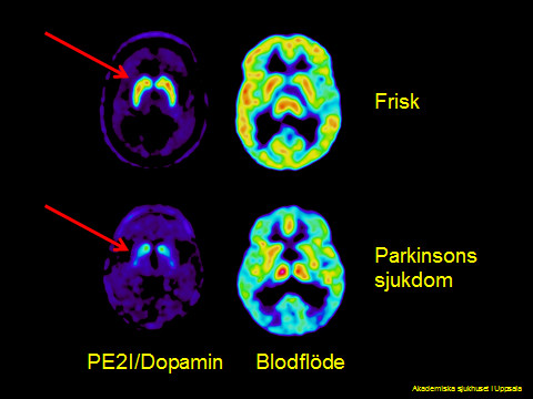pet-ct-parkinssons
